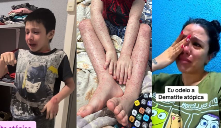 Desesperada, mãe implora por tratamento: Filho chega a pedir para morrer por causa de doença de pele que sangra sem parar